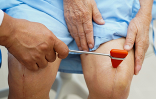 Revision Knee Replacement