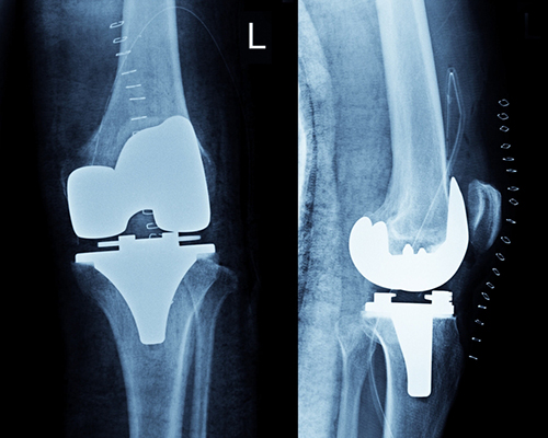 Knee Replacement